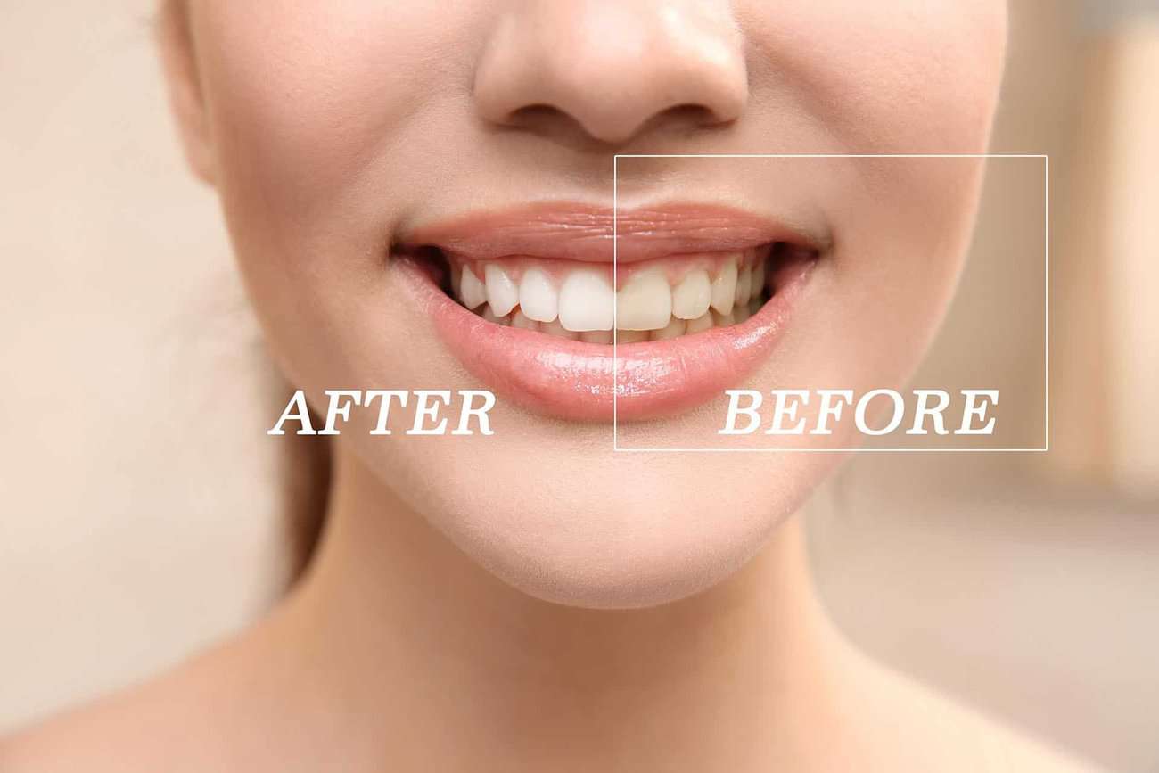 What Are the Most Effective Natural Teeth Whitening Methods You Can Try Wembley?