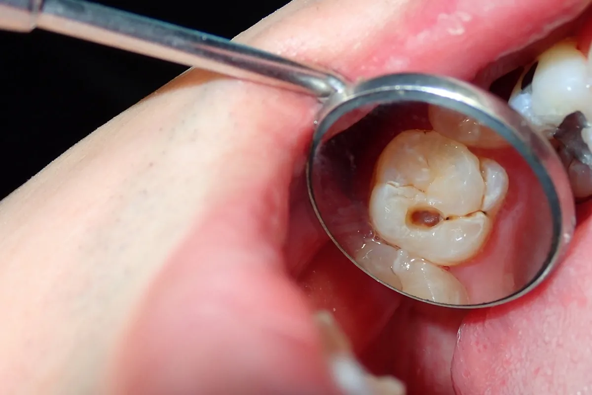 Why Do Teeth Crack? Common Causes to Know Wembley