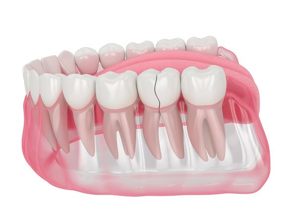 How Can You Manage Pain and Discomfort After a Root Canal Wembley?