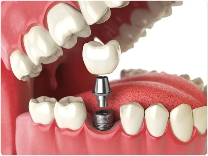 How Do I Decide Which Tooth Replacement Is Right for Me Wembley?