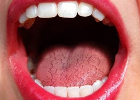 Common Causes of Dry Mouth (Xerostomia) Wembley