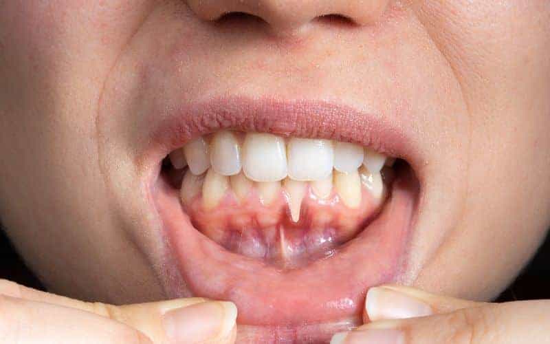 How Can Gum Disease Be Prevented Wembley?