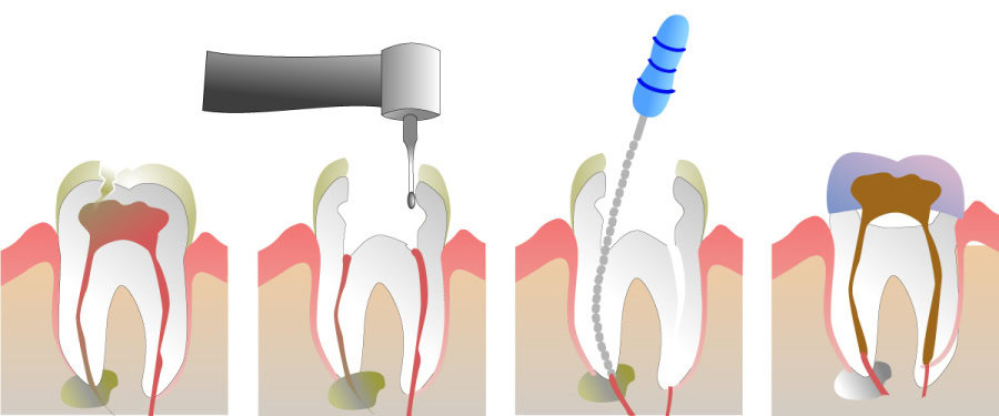 How Do You Properly Care for Your Teeth After a Root Canal Wembley