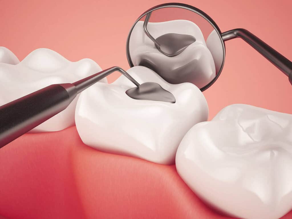 Fighting Cavities and Plaque Buildup Wembley