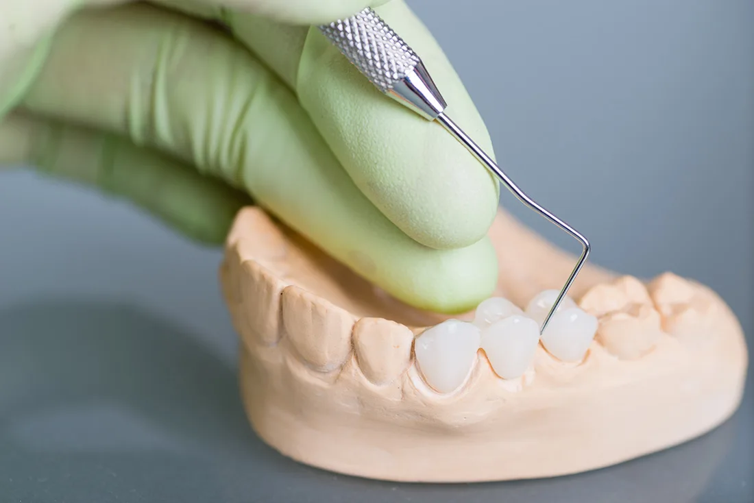 What Are the Different Types of Dental Crowns Available Wembley?