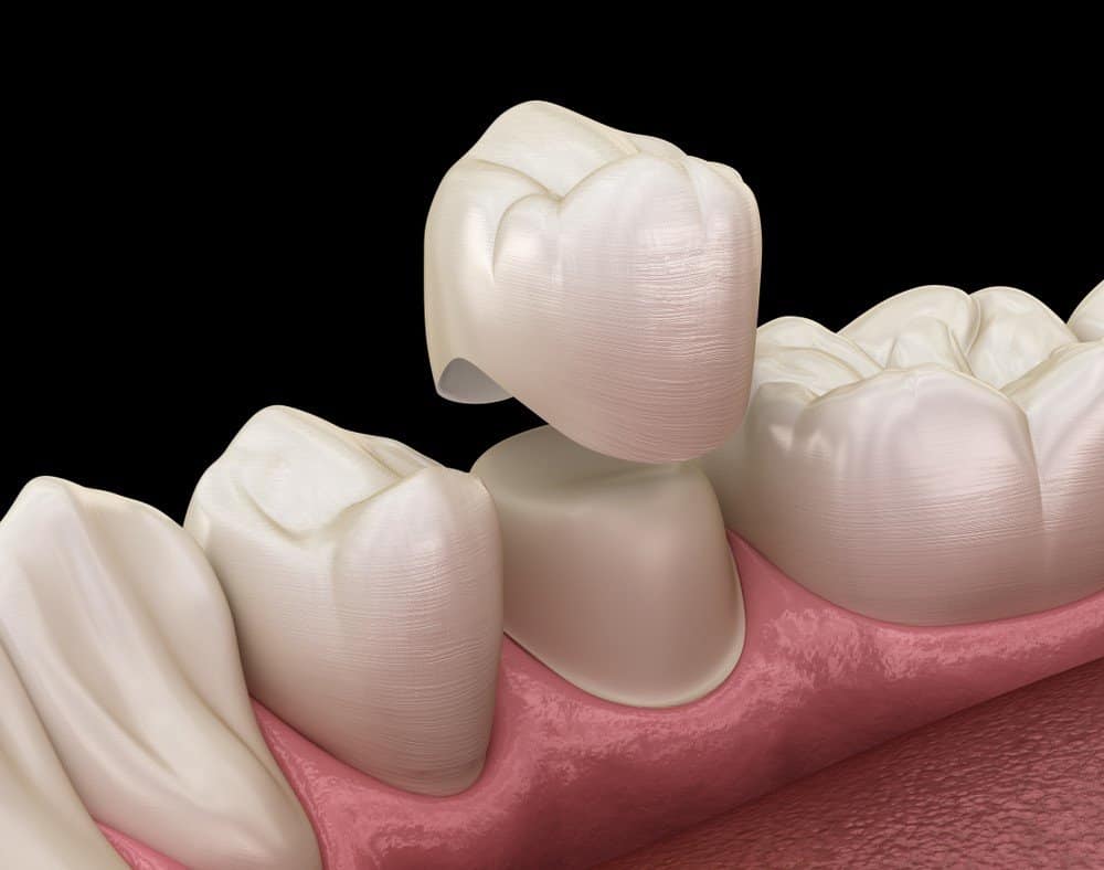 How Can You Prevent Common Dental Crown Problems Wembley?