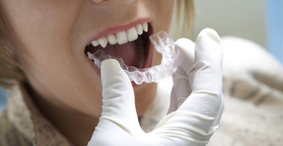 How Much Does Laser Teeth Whitening Cost Compared to Overnight Trays Wembley?